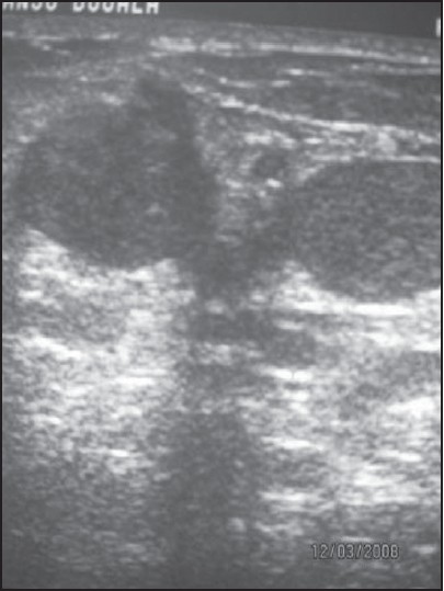 Figure 2: Same sonogram showing echo-rich cystic mass of breast abscess