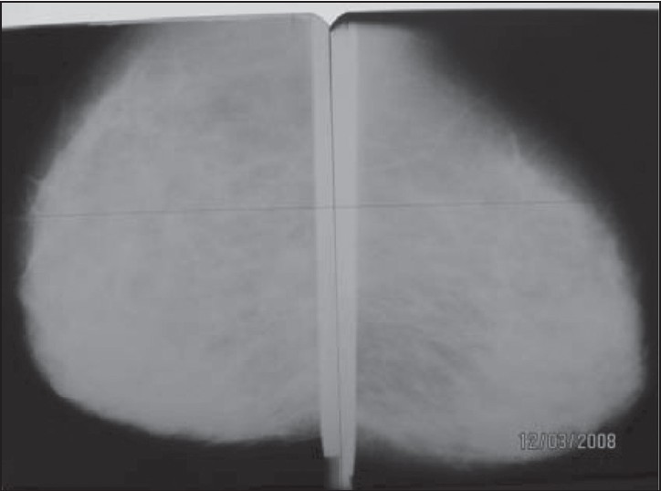 Figure 3: Mammogram showing dense breast