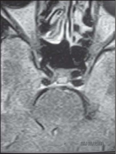Figure 4: FLAIR brain MRI showing hyper intense intrasellar pituitary mass