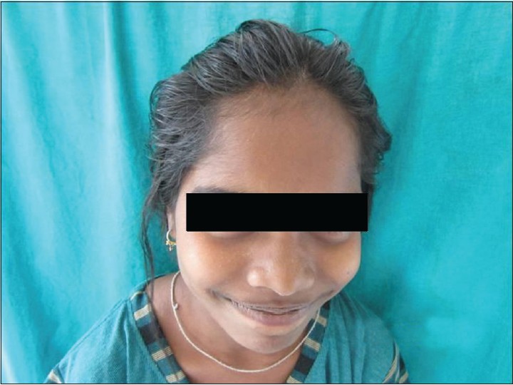 Figure 1: 14-year-old girl with frontal alopecia