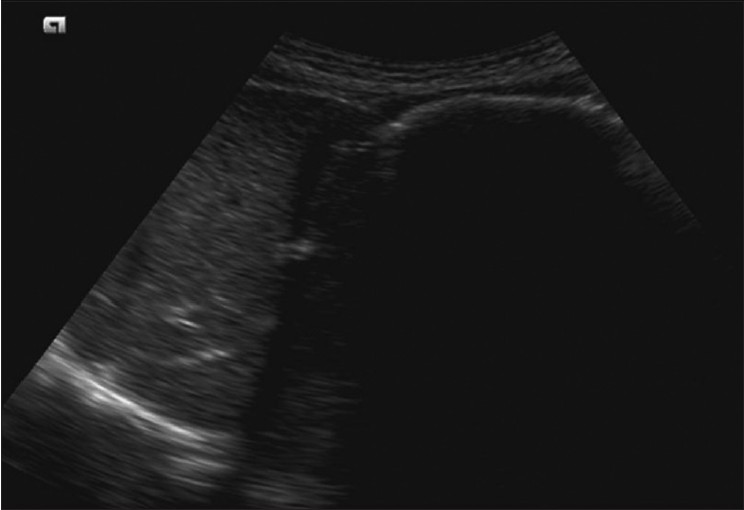 Figure 2: Ultrasound abdomen showing the presence of a gastric mass