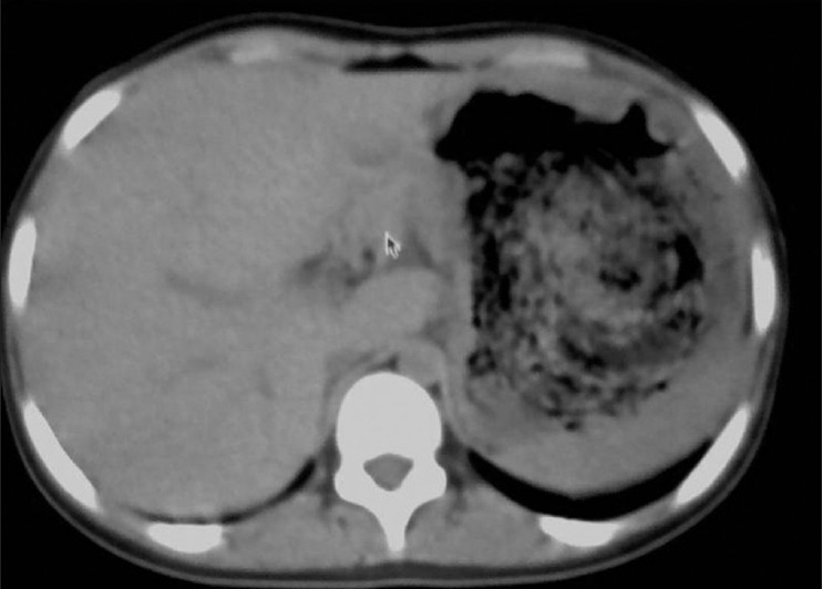 Figure 3: Contrast enhanced computed tomography abdomen showing large gastric mass with internal air loculi involving the entire stomach with extension into the duodenum but not into the jejunum