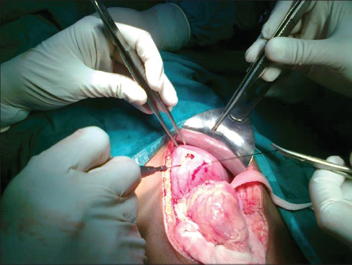 Figure 5: Intraoperative image showing gastrostomy