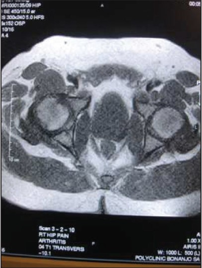 Figure 3: T1 Weighted MR image. This shows that both femoral heads are within the acetabular cavity. Bur note cartilage fissuring and narrowed hip joint in osteoarthritis