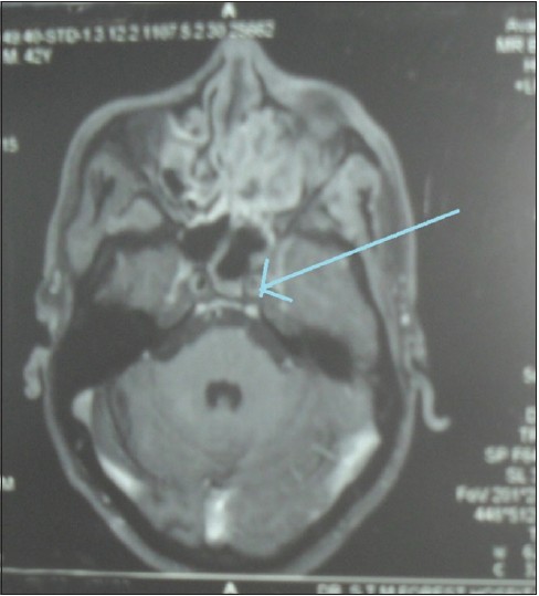 Figure 3: Magnetic resonance imaging brain showing narrowed left internal carotid artery (blue arrow)