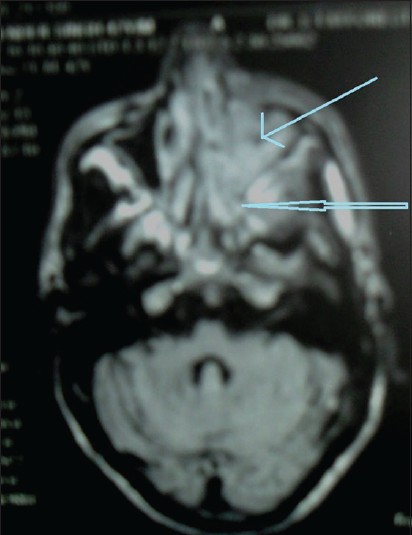 Figure 4: Magnetic resonance imaging brain showing left maxillary (thin blue arrow), ethmoidal and sphenoidal sinusitis (empty arrow)