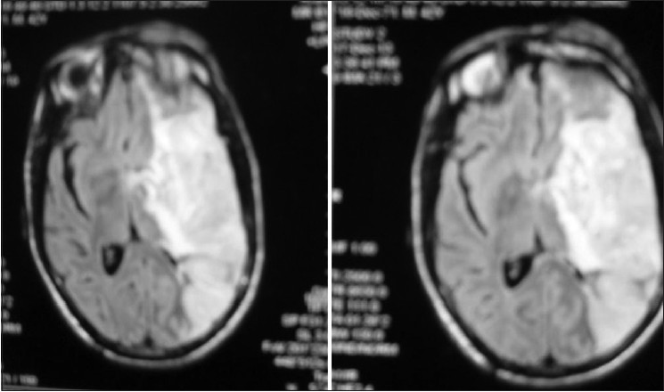 Figure 5: Magnetic resonance imaging brain showing large infarct in left fronto-tempero-parietal lobes, appears bright signal on diffusion weighted imaging sequences indicating restricted diffusion