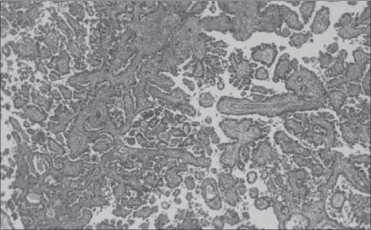 Figure 2: Photomicrograph of clear cell adenocarcinoma of the cervix showing numerous glands and cancer cell infi ltration (H and E, ×40)