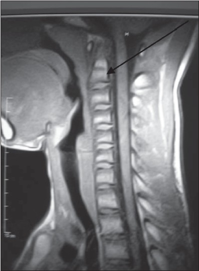 Figure 1: T1-weighted mid-sagittal magnetic resonance imaging showing a hair-line signal void linear lesion located antero-superior to the odontoid process of the axis vertebra