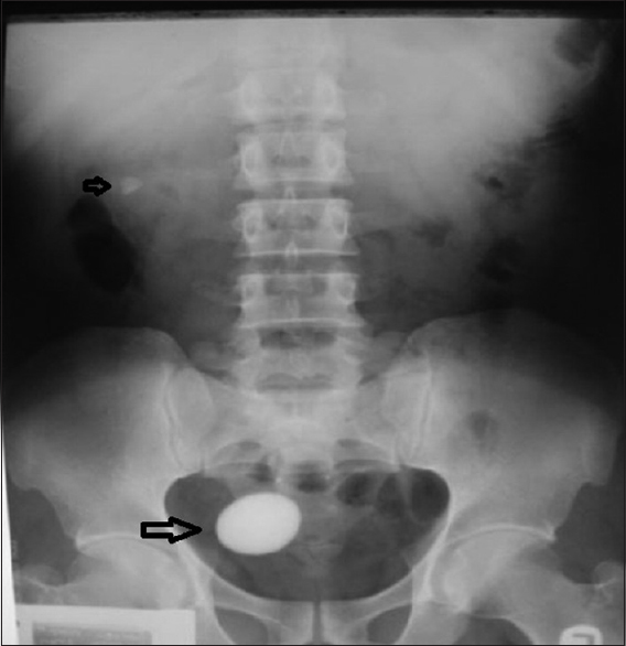 Figure 1:  A  plain radiograph is showing an oval shaped calculus within the pelvis (bigger arrow). A calculus is also seen within the right renal bed (smaller arrow)
