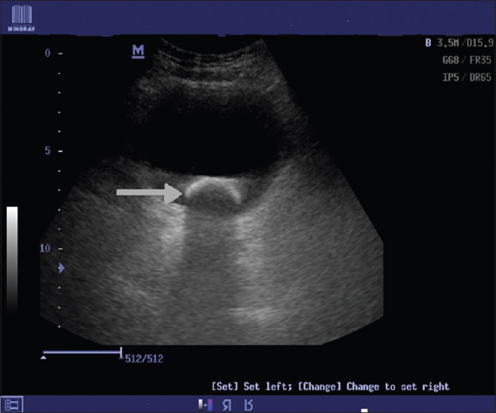 Figure 2:  A  transverse pelvic ultrasound scan demonstrating the echogenic rim of a calculus (arrow) casting a posterior acoustic shadow within the bladder
