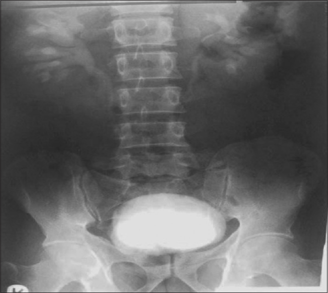 Figure 3:  A  30 min intravenous urogram. The stones are obscured; note the right sided pelvicalyceal dilatation