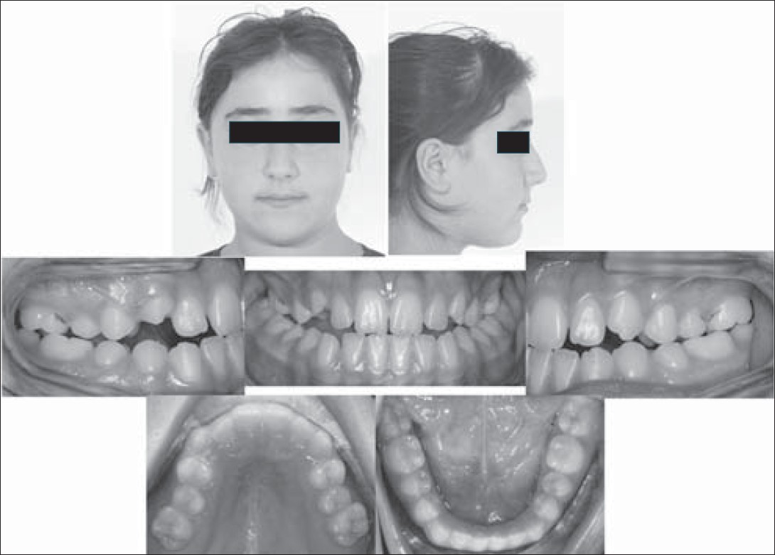 Figure 1: Intraoral and extraoral photographs of the patient at the beginning of face mask therapy