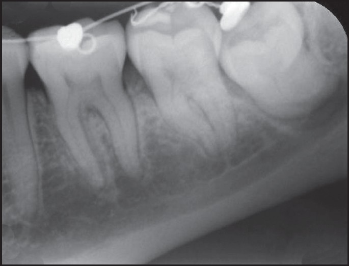 Figure 3: Periapical radiograph showing the separation of the impacted tooth from inferior alveolar nerve