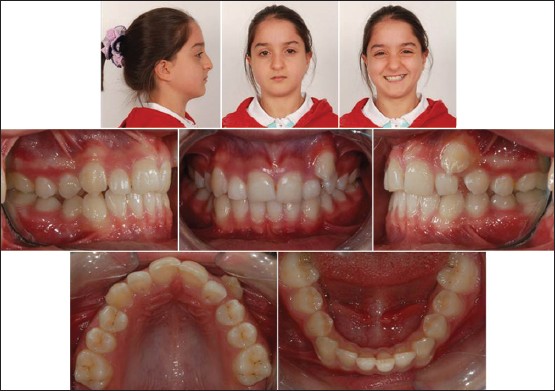 Figure 1: Pre-treatment facial and intraoral photographs