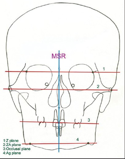 Figure 3: Mid-sagittal reference line and horizontal planes