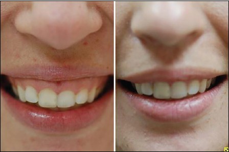 Figure 2: Gummy smile at lip rest