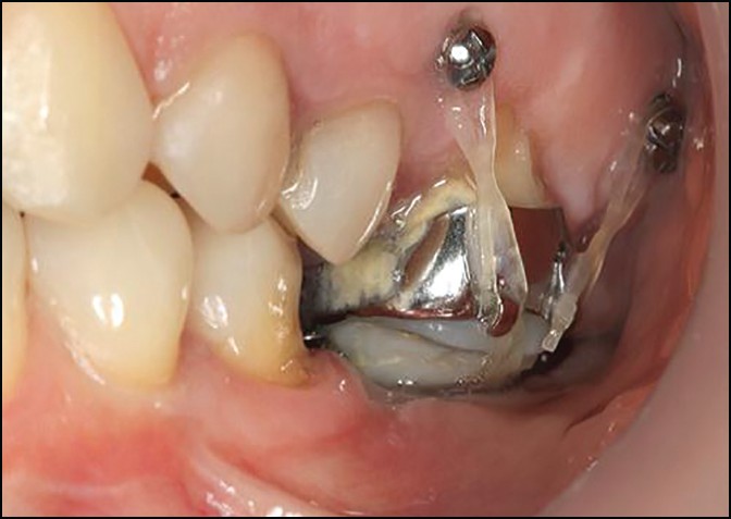 Figure 3: Intrusion of posterior teeth