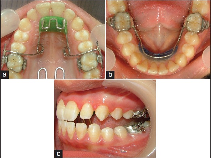 Figure 1: Fixed lingual mandibular growth modifi cator: (a) The maxillary part; (b) the mandibular part; (c) the patient occludes in the therapeutic anterior position (edge to edge)