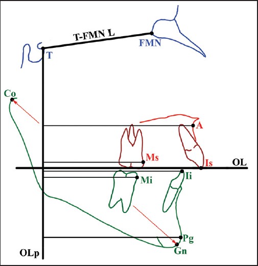 Figure 2: Sagittal occlusal analysis. In addition to traditional landmarks, two reference points were used: Frontomaxillary nasal suture (FMN); T point, most superior point of the anterior wall of sella turcica at the junction with tuberculum sellae. Registration line used: T-FMN L, line used for superimposition of two cephalograms with T point as the registration point. Reference coordination system (occlusal line [OL] and occlusal line perpendicular [OLp]): OL, a line through incisal tip of upper incisors and distobuccal cusp of upper permanent fi rst molars; OLp, a line perpendicular to OL through T point