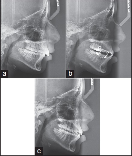 Figure 4: A 13.4-year-old girl treated with fixed lingual mandibular growth modificator. (a) Before treatment; (b) treatment beginning; (c) after 8 months of orthopedic correction, sagittal occlusal relationships obviously improved and an acceptable posterior interdigitation was established