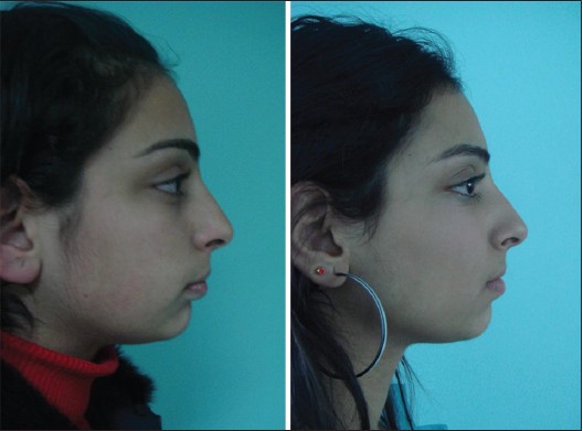 Figure 1: One of the patients profi le photos, before and after the treatment