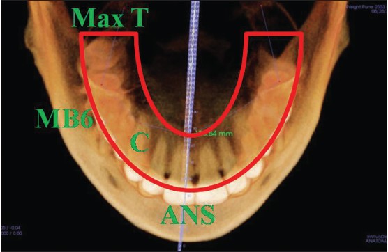 Figure 8: Maxillary basal curve length