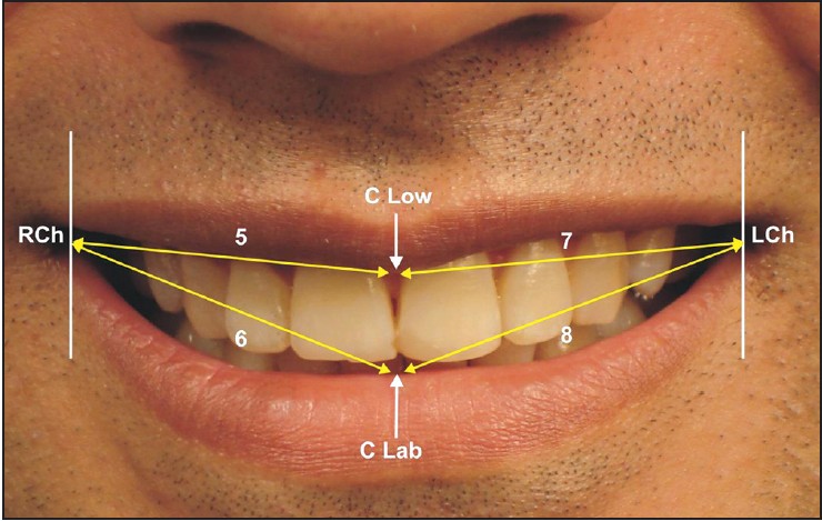 Figure 3: Linear measurements in the transverse plane: 5. Distance between the innermost corner of the right side of the lip to the most inferior point on the inferior curvature of the upper lip (RCh to CLow), 6. Distance between the innermost corner of the right side of the lip to the midmost point on the upper curvature of the lower lip, directly inferior to point C (RCh to Clab), 7. Distance between the innermost corner of the left side of the lip to the inferior point on the inferior curvature of the upper lip (LCh to CLow), 8. Distance between the innermost corner of the left side of lip to the midmost point on the upper curvature of the lower lip, directly inferior to point C (LCh to Clab)