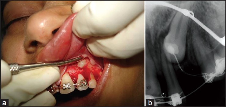 Figure 4: (a) Surgical exposure of impacted maxillary left canine. (b) Intra oral periapical X-ray showing lingual button with pig-tail tie attached with 0.019 × 0.025 stainless steel arch wire