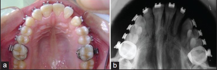 Figure 5: Mid treatment maxillary occlusal photograph (a) and occlusal radiograph (b)