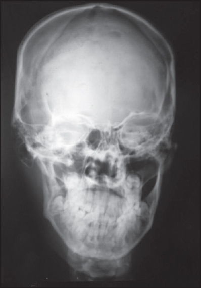 Figure 7: Posteroanterior cephalogram in a case of facial asymmetry