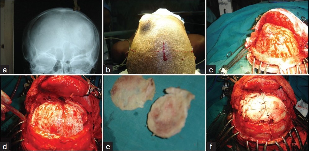 Figure 1: Treatment of patient with a massive osteoma of the left frontal bone