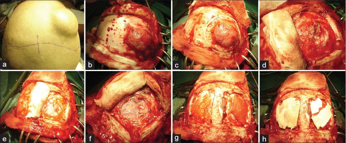 Figure 2: A case of large Ewing's sarcoma involving the right frontal bone
