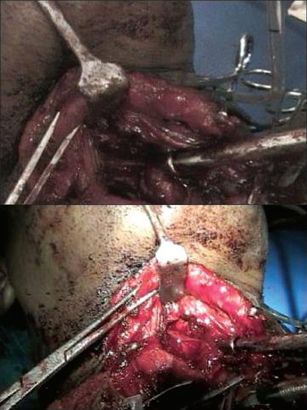 Figure 2: (a)Neck-dissection total laryngectomy
Figure 2b: Neck-dissection total laryngectomy