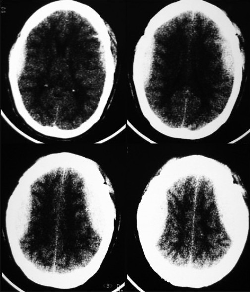 Figure 1: CT scan showing bilateral parietal EDH