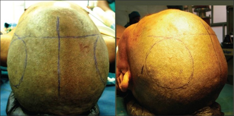 Figure 2: Clinical image showing marking of coronal suture, midline, and approximate location of extradural hematomas