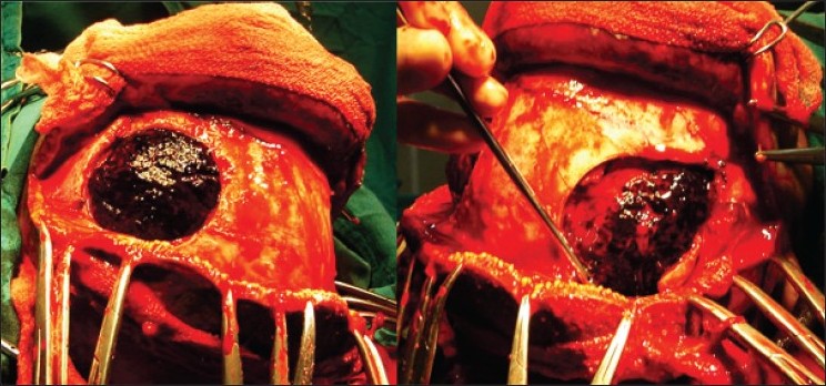 Figure 4: Intraoperative photograph showing bilateral trephine craniotomy and exposure of extradural blood clot