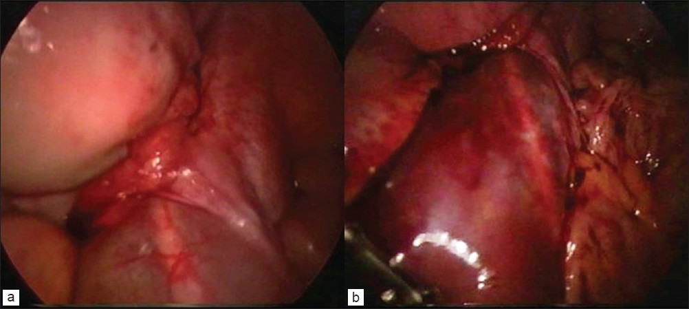 Figure 1: (a-b)Laparoscopic view of the retroperitoneal hematoma
