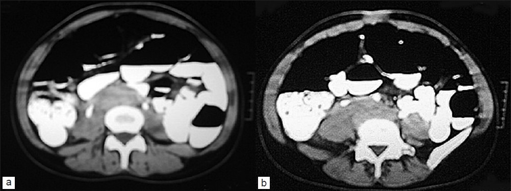 Figure 2: (a-b)Postoperative CT scan of the abdomen