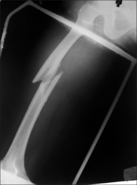 Figure 1: Preoperative radiograph of a 30-year old women who sustained trauma showing comminuted fracture of femur, primarily splinted