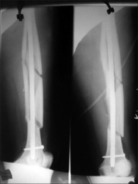 Figure 2: Postoperative radiograph shows fixation of fracture with closed intramedullary interlocking nail