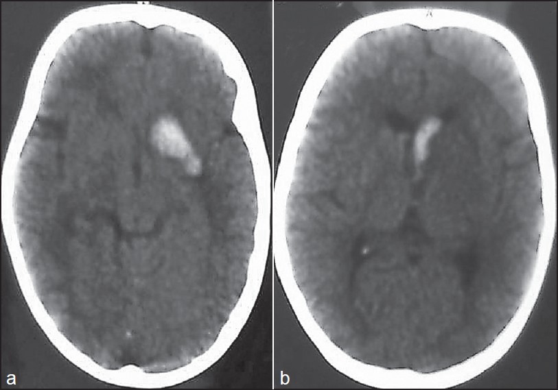Figure 1: CT brain showing (a) intracerebral hemorrhage (b) intraventricular hemorrhage