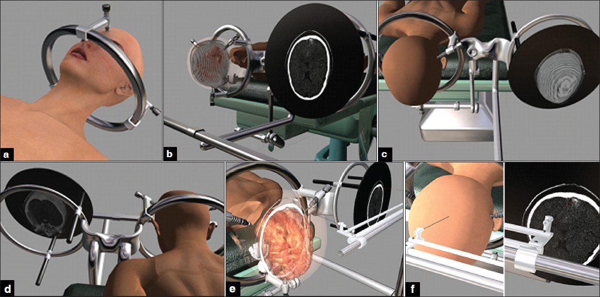 Figure 1: An occipital cavernous angioma at the tip of left occipital lobe. (a) The frame has been fi xed to the cranium. (b) The head of the patient have been fi xed to operating table at prone position and the images have been transferred to monitor. (c and d) The patient and images data have been adjusted. (e and f) The pantoghraph show that the data of the patient head and pathology are seen at the same location of their counterpart on LCD.