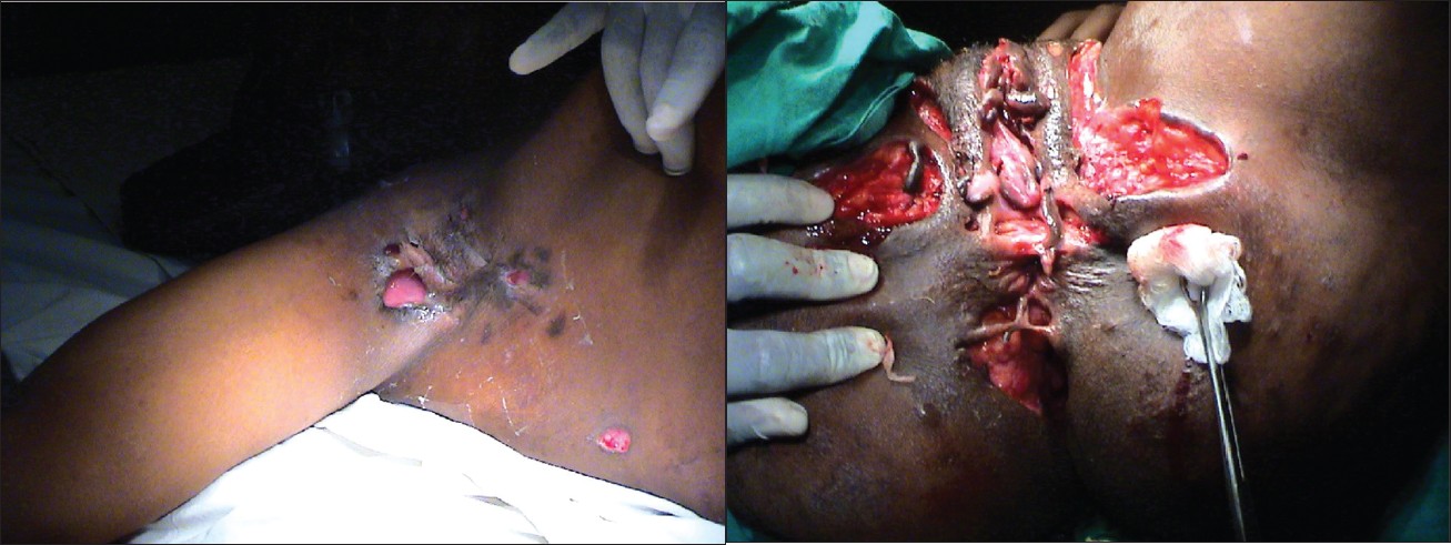 Figure 1: a: Right axillary cutaneous aspergillosis, preoperative 
Figure 1: b: Cutaneous aspergillosis of the perineum of the same patient, preoperative