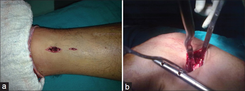 Figure 4: (a) Incision given for tibial interlocking; (b) Enlargement of the near cortex using bone awl