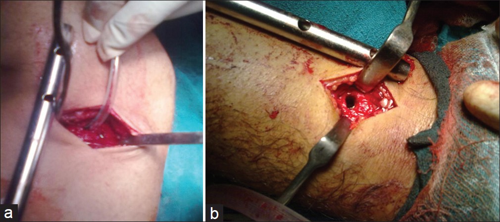 Figure 5: (a) Using Ryle's tube to suction intramedullary blood; (b) Enlarged distal tibial intramedullary nail hole