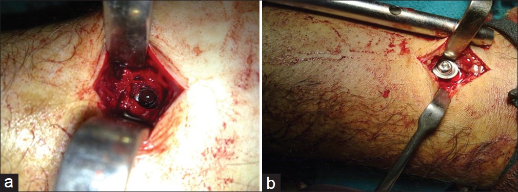 Figure 6: (a) The distal hole in the intramedullary nail seen through bone; (b) Insertion of distal interlocking screw with washer