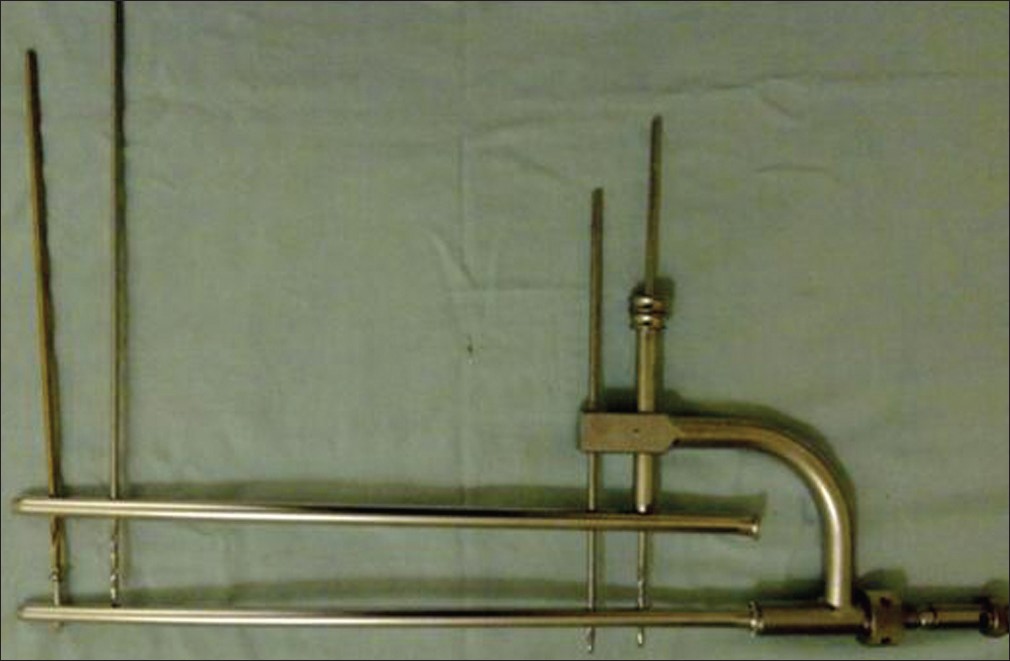 Figure 7: Technique of inserting antecedent distal locking screws
