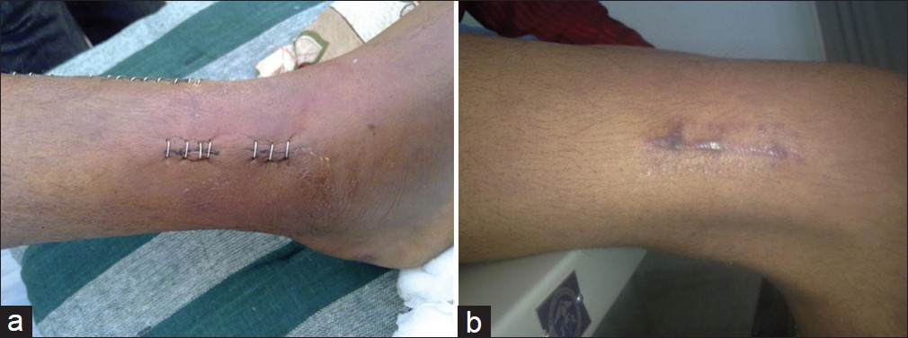 Figure 9: (a) Wound site; (b) Postoperative photograph of fracture femur patient