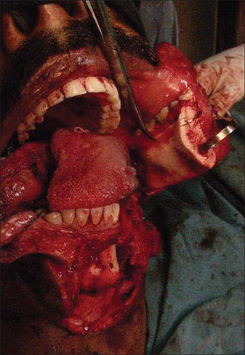 Figure 1: Intraoperative photograph showing the mandible where the gingival mucosa is removed as part of the margin of resection